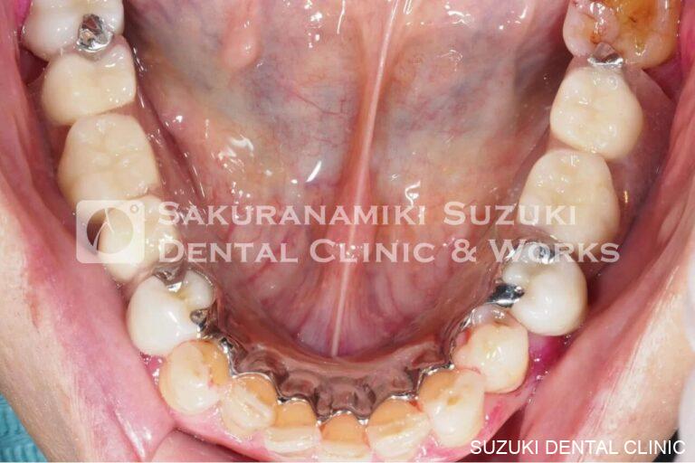 有床義歯(入れ歯)