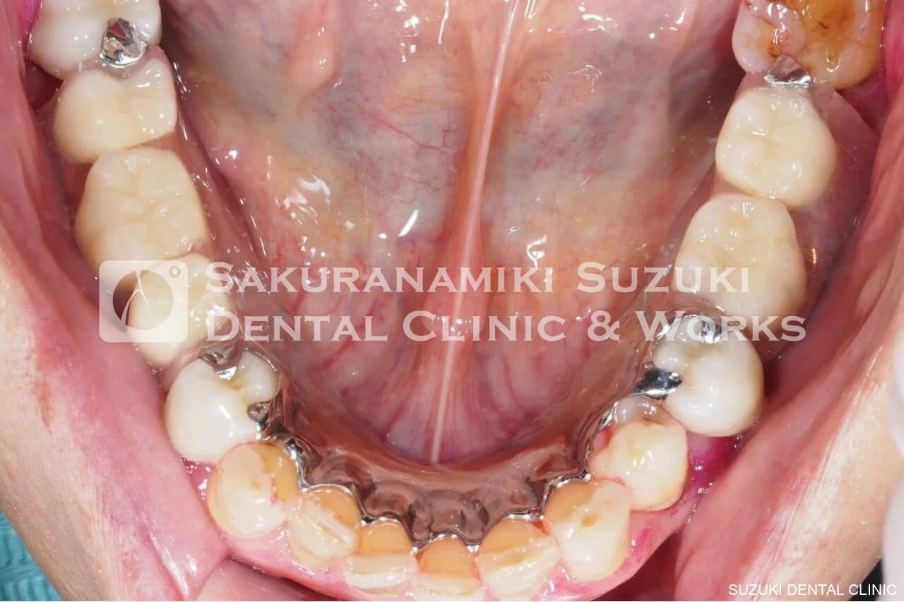 有床義歯(入れ歯)